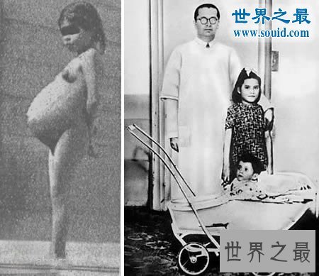 中国最年轻的妈妈，9岁女童剖腹产男婴