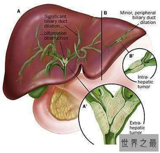 十大致命类型的癌症，都是很难治愈的癌症！