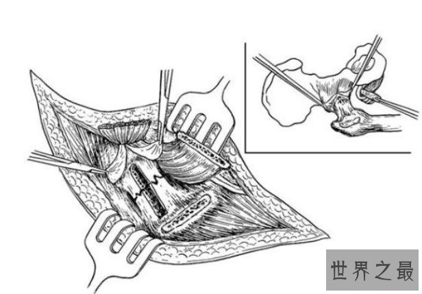 世界最早的骨移植手术，《江氏伤科方书》