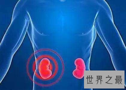 世界上肾最多的人，新西兰男子同时拥有5个正常肾脏