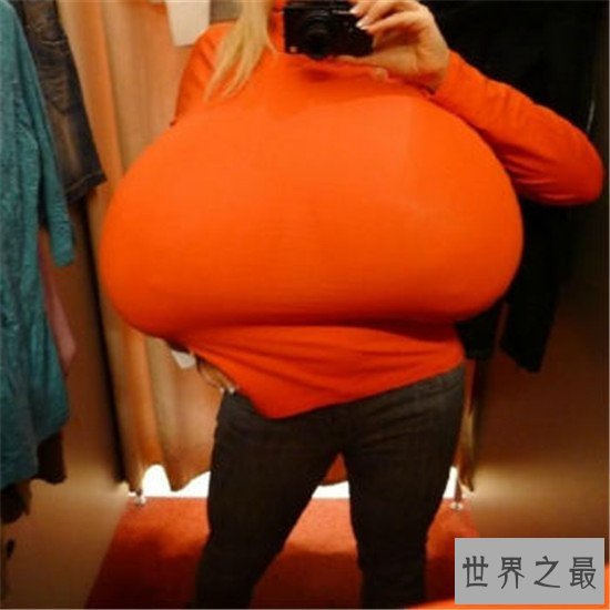 世界上最大的天然乳房，双乳重达77斤（图）