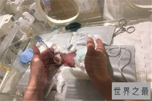 最小存活婴儿出院怎么回事，惊掉医学天才的下巴