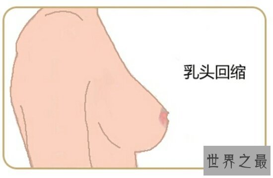 看懂早期乳腺癌图片 早知道早治疗