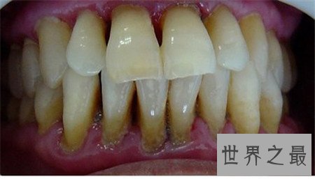 牙龈炎图片 快进来对比一下你有没有牙龈炎