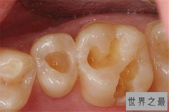 虫牙怎么办？长期清洁不当则会造成牙齿损坏