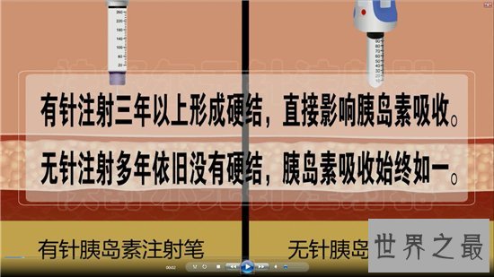 无针注射器用于糖尿病患者，随时都可以注射胰岛素