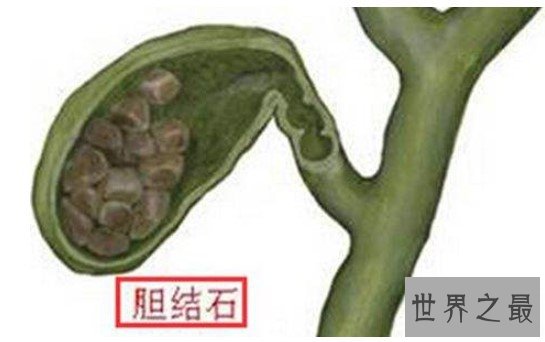 世界上最大的人体胆结石，重达12.58千克