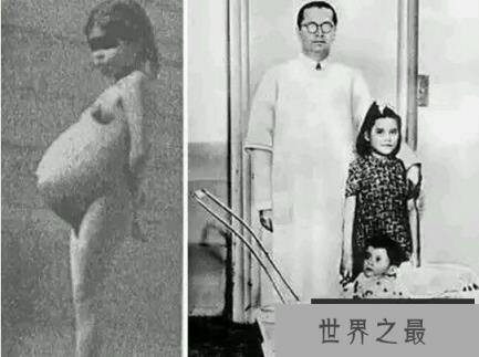 盘点世界上年龄最小的妈妈，秘鲁少女成最小（年仅5岁）