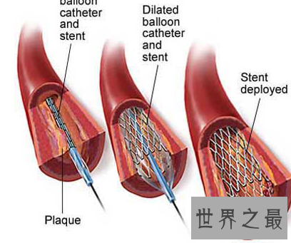 【图】心肌梗塞：别让心脑血管疾病控制你的生存