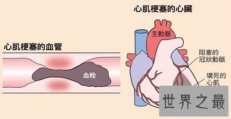 【图】心肌梗塞：别让心脑血管疾病控制你的生存