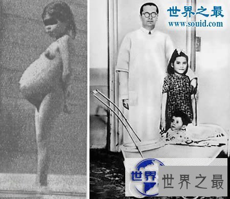 【图】世界上最重的女婴，印度19岁女孩生13.6斤重巨婴