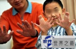 【图】世界手指和脚趾最多的人，15个手指/16个脚趾